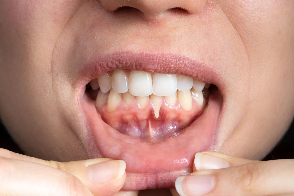 Gum Disease Treatment (Periodontal Care) image 1