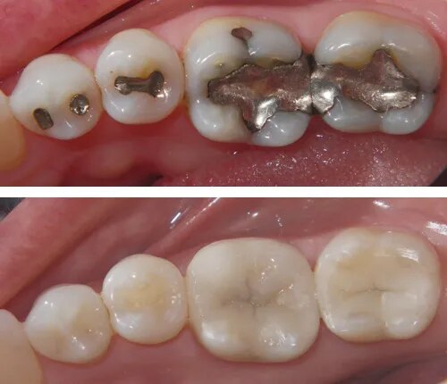 Tooth-Colored Fillings & Restorations image 1
