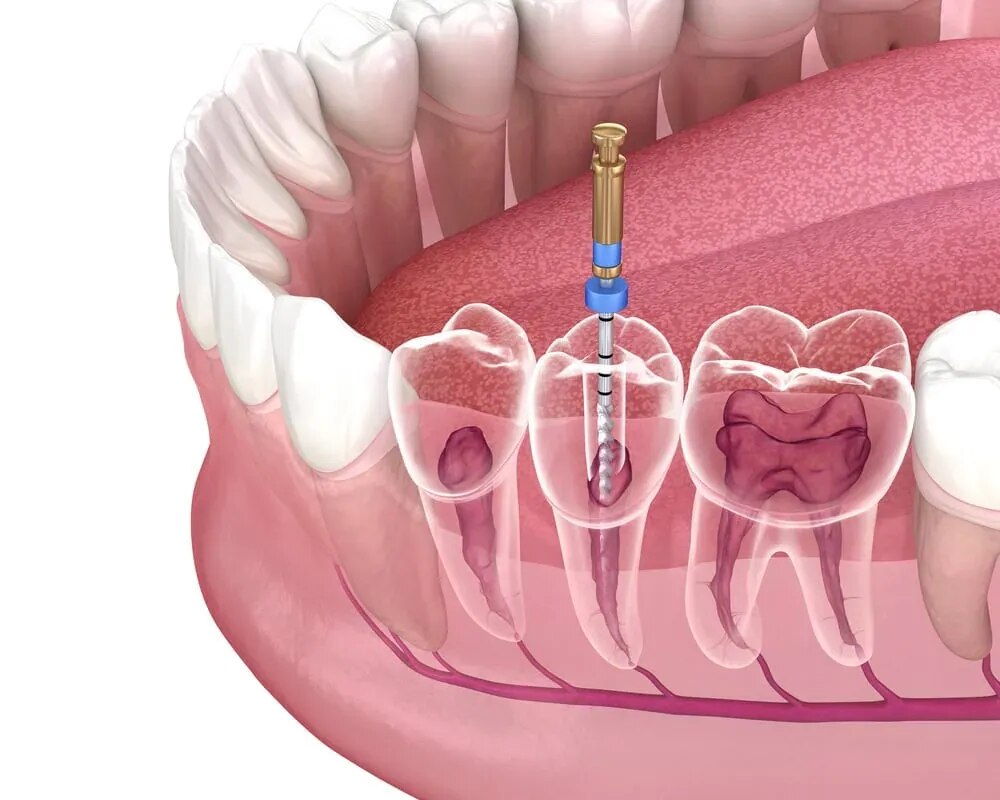 Root Canal Treatment (RCT) in Jaipur
image 1