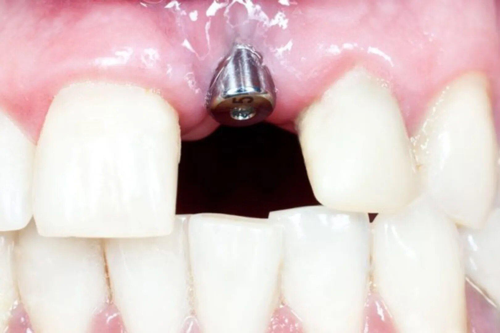 Dental Implants in Jaipur image 1
