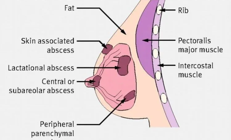 Breast Abscess Surgery image 1