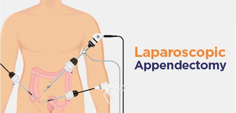 Laparoscopic Appendectomy image 1