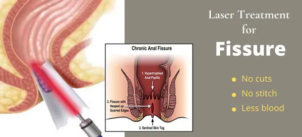Laser Fissure Surgery image 1