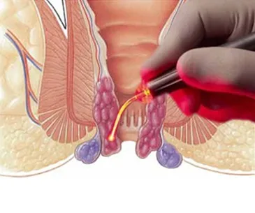 Laser Piles Treatment image 1