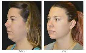 Double chin Reduction  image 1