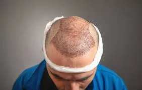 Hair Transplant  image 1
