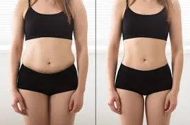 Laser Liposuction image 1