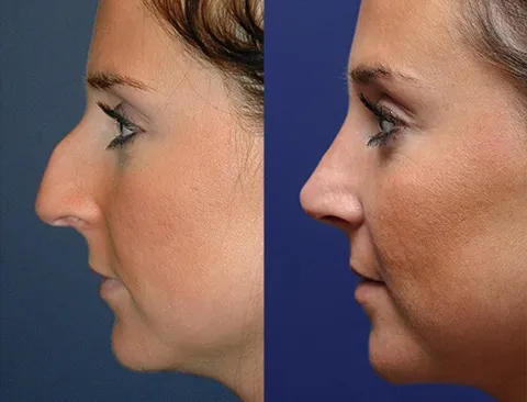 Rhinoplasty image 1