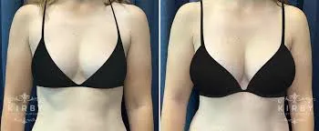 Breast Enhancement Surgery image 1