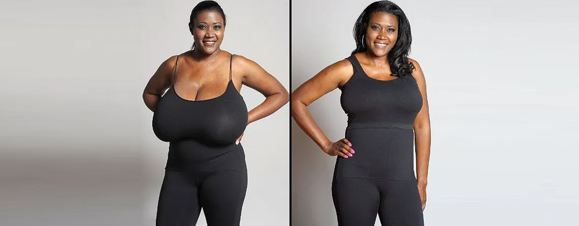 Breast Reduction Surgery image 1