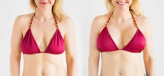 Breast Lift Surgery image 1