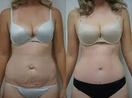 Tummy tuck surgery  image 1