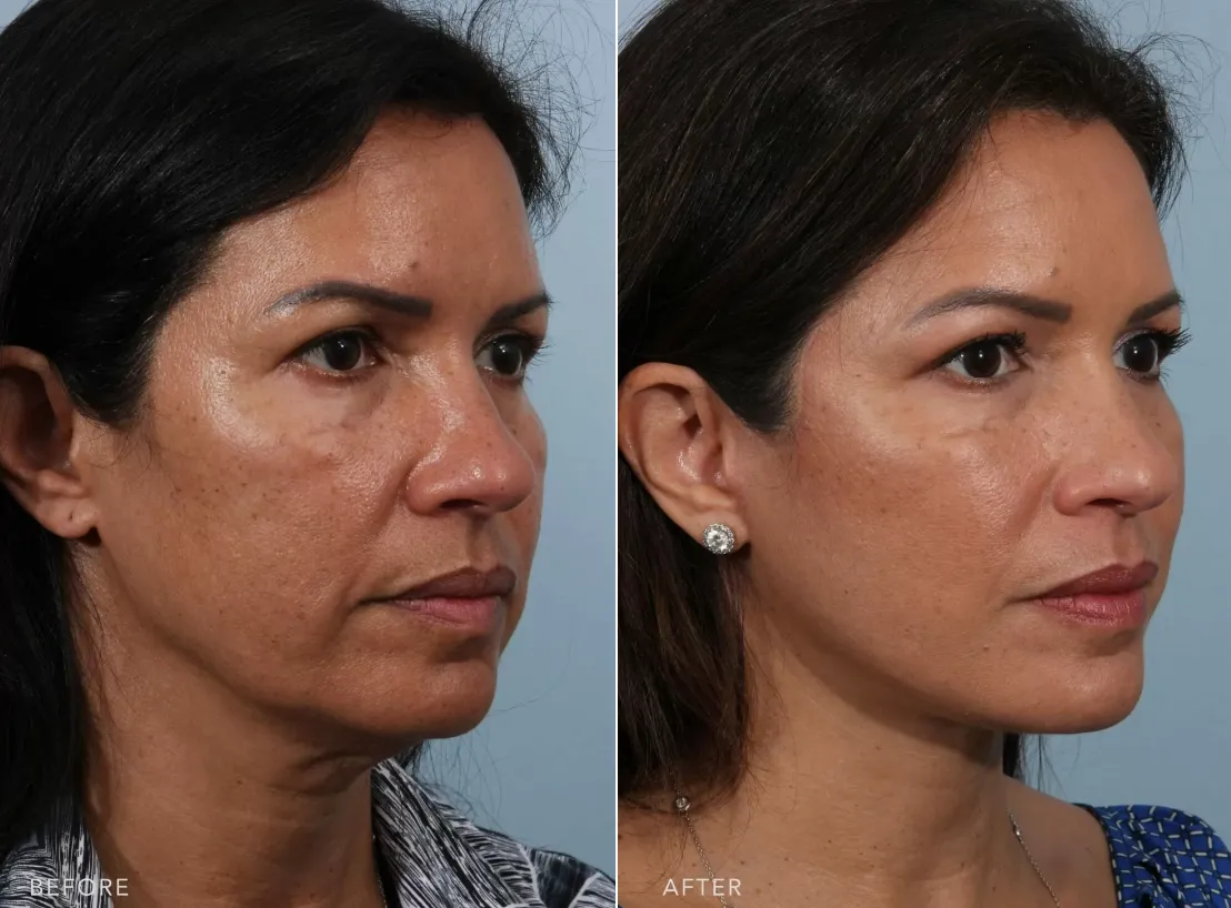 Face Lift Surgery image 1