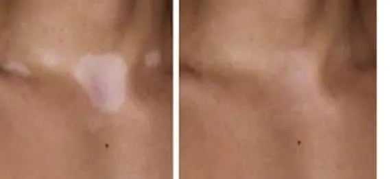 Vitiligo / Hypopigmentation camouflage image 1