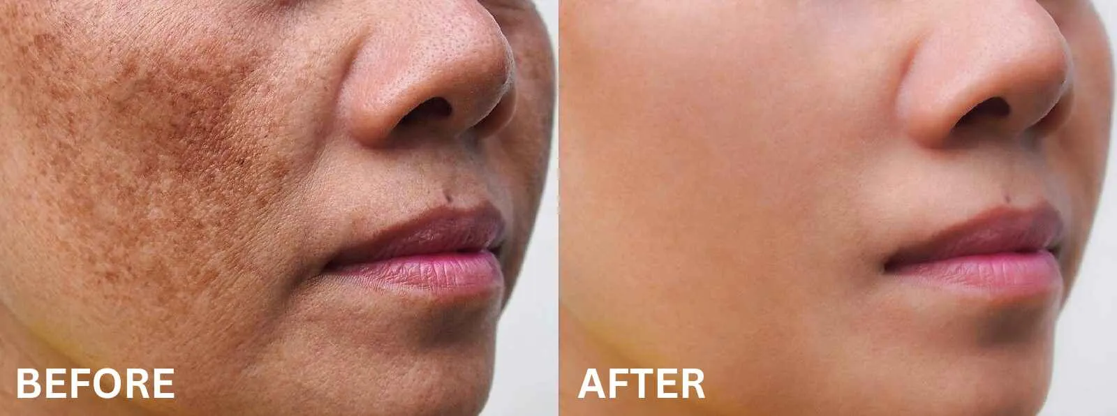 Melasma/ Hyperpigmentation Treatments image 1
