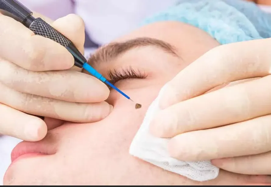 Wart, Mole& Skin tag removal image 1