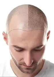 Scalp micropigmentation image 1