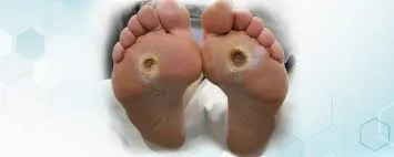 Ulcer Healing Surgery image 1