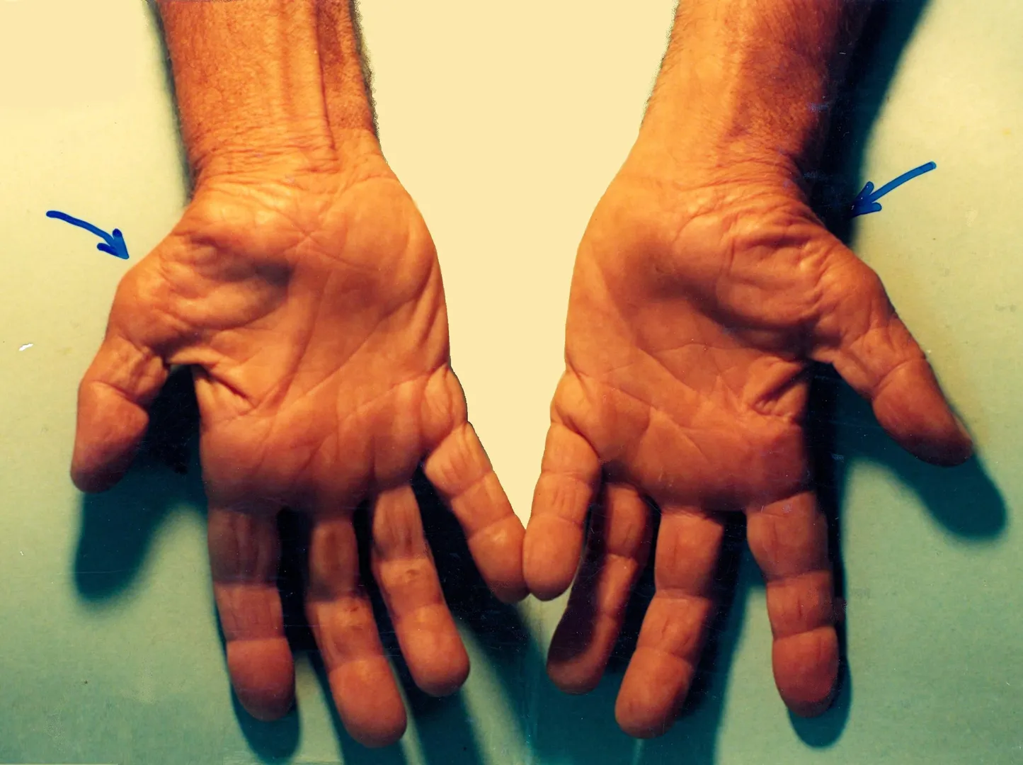 Carpal Tunnel Disorder image 1
