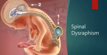 Spinal Dysraphism image 1