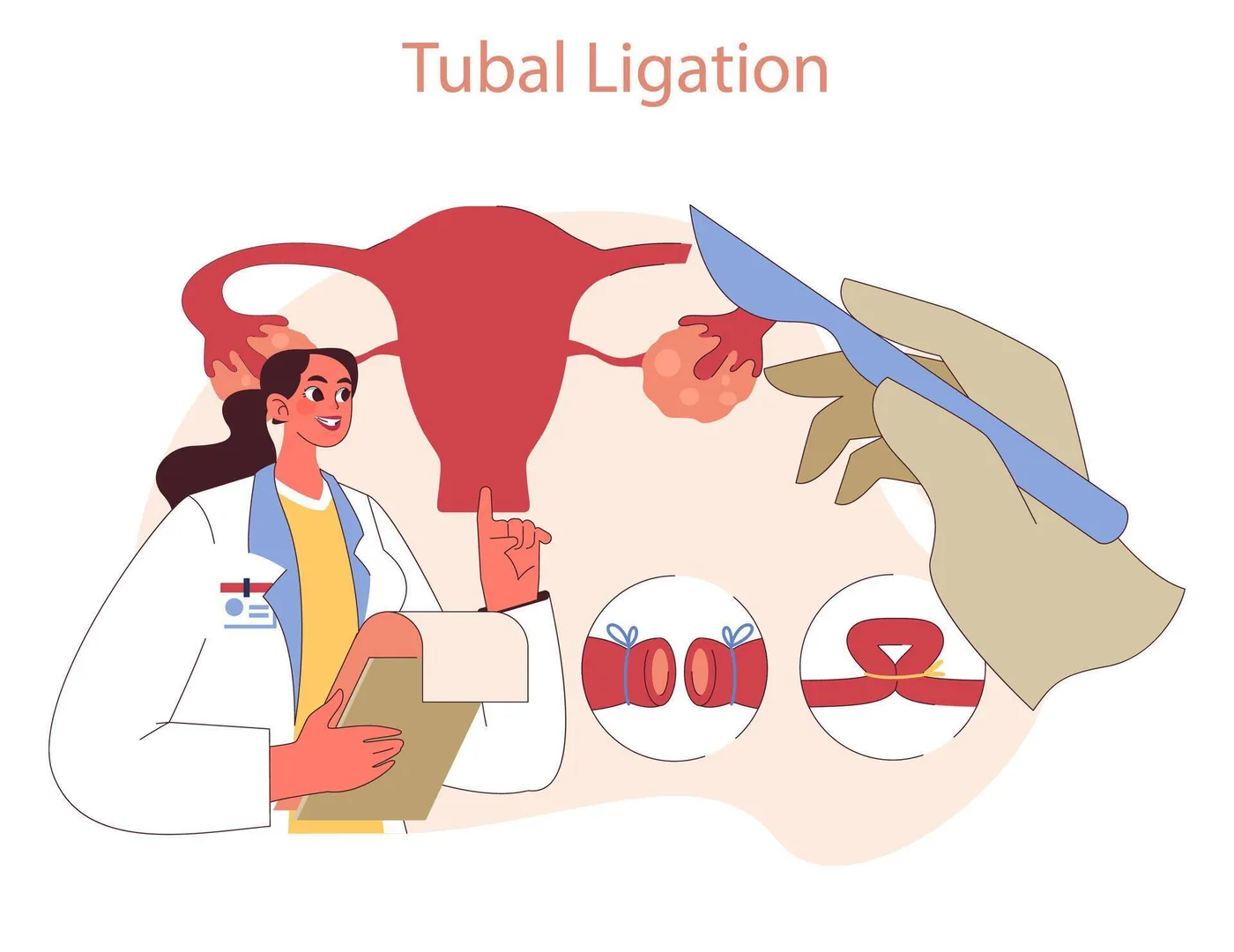 Tubal Ligation image 1