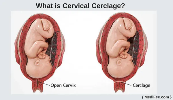 Cervical Cerclage  image 1