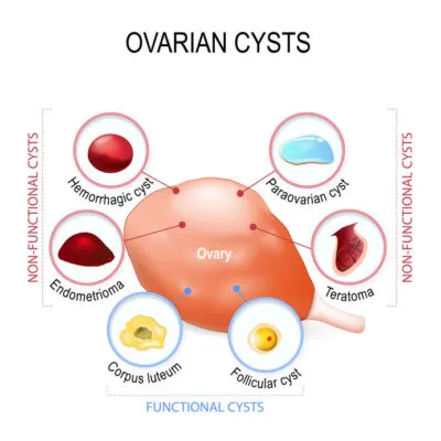 Ovarian Cyst image 1
