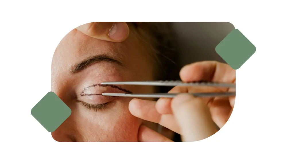 Blepharoplasty (Eyelid Surgery) image 1