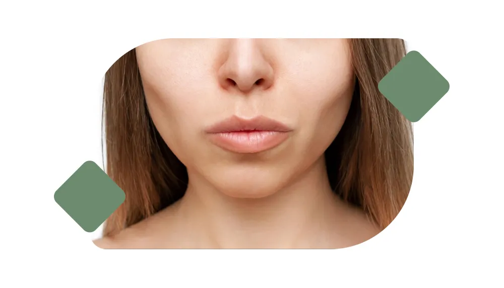Buccal Fat Removal image 1