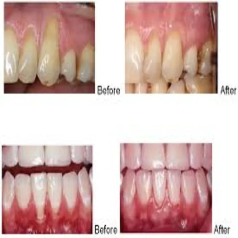Periodontal Surgery image 1