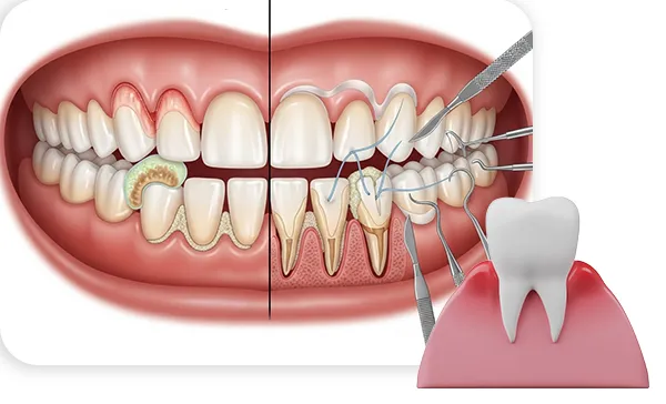Gum Health & Periodontal Flap Surgery image 1