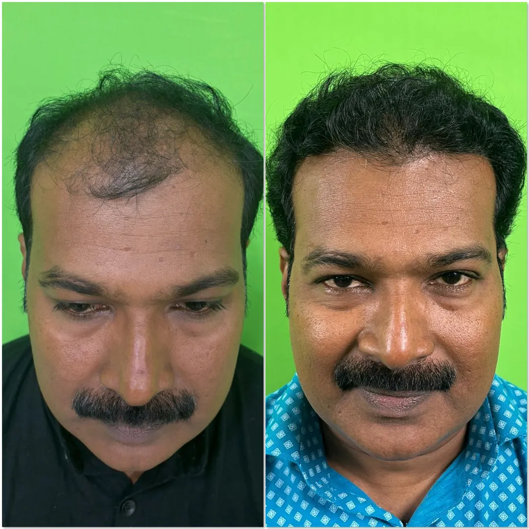 ADVANCE HAIR TRANSPLANT SURGERY image 1