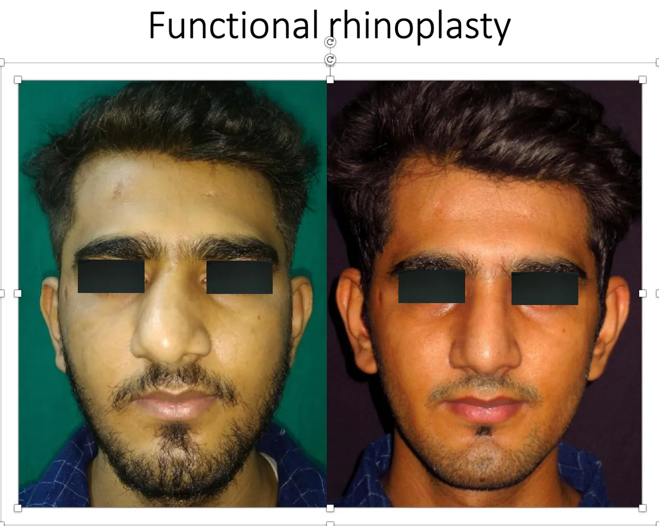 RHINOPLASTY - NOSEJOBS image 1