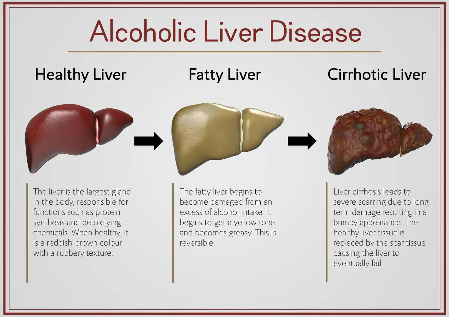 ALCOHOLIC LIVER DISEASES MANAGEMENT image 1