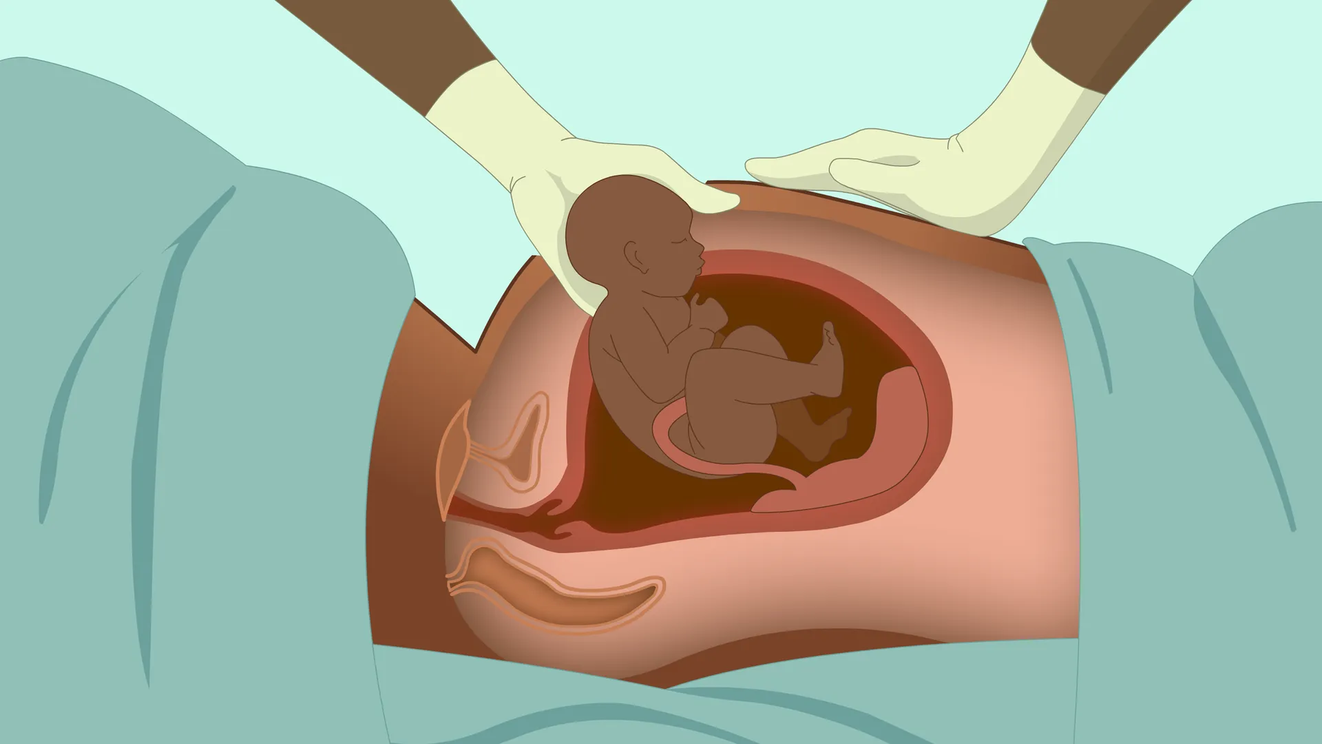 C-Section (Cesarean Delivery) image 1