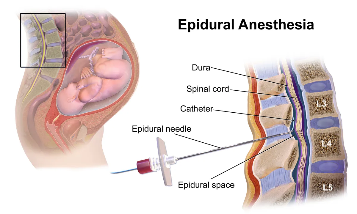 Labour Pain Management (Epidural) image 1