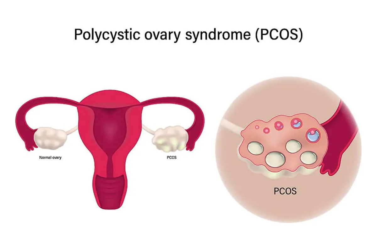 PCOS Treatment image 1