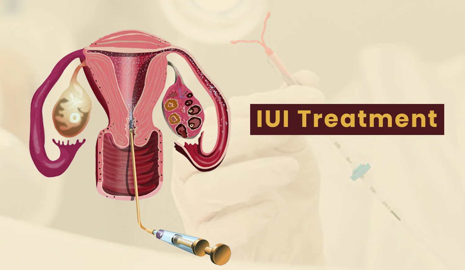 IUI (Intrauterine Insemination) Treatment image 1