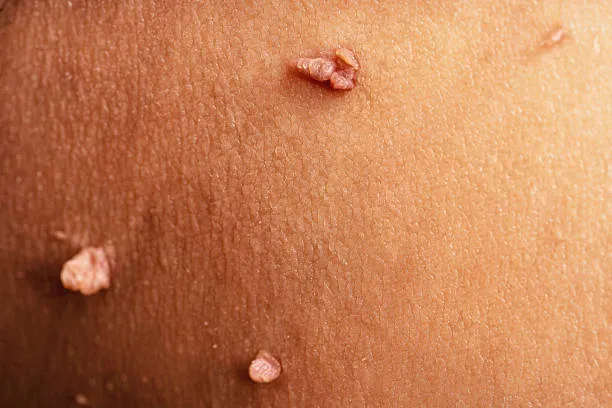 Warts image 1