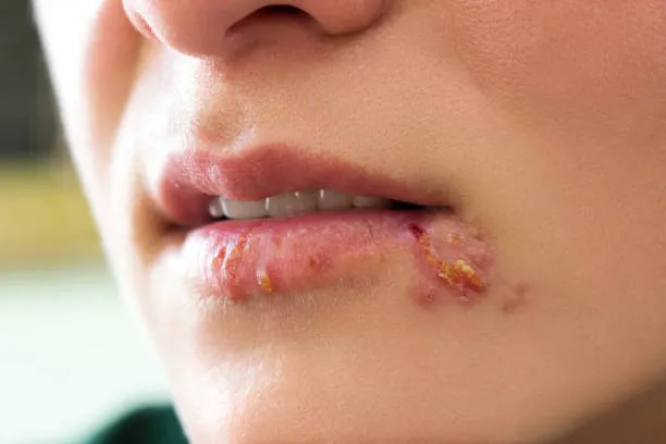 Herpes image 1