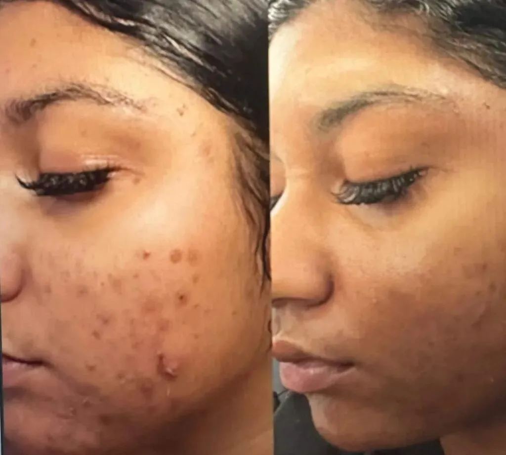 CHEMICAL PEEL image 1