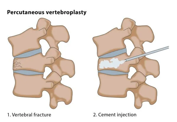 Vertebroplasty Treatment image 1