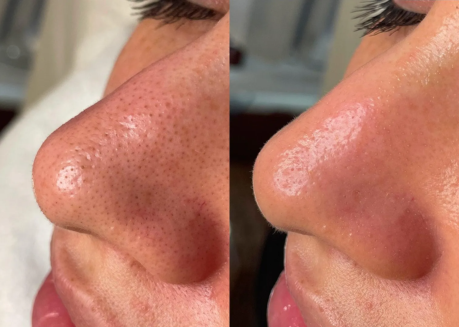 HYDRAFACIAL image 1