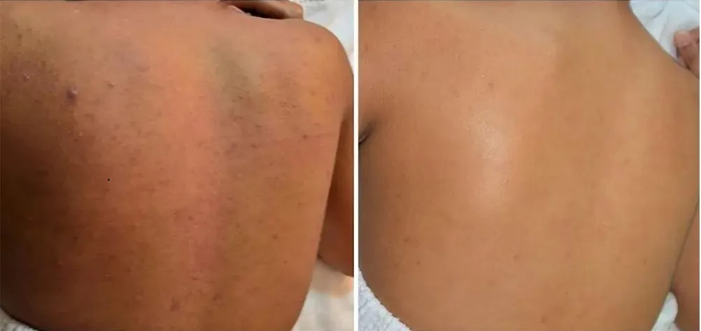 Chemical peel image 1