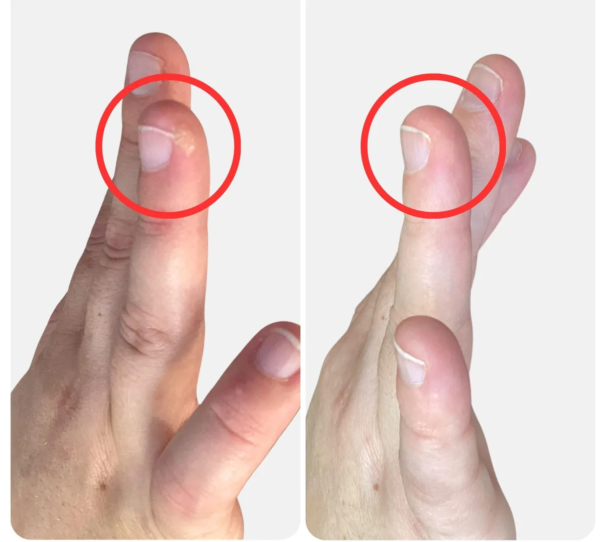 Wart removal image 1