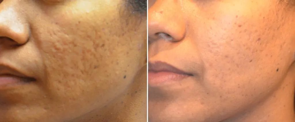 Microneedling image 1