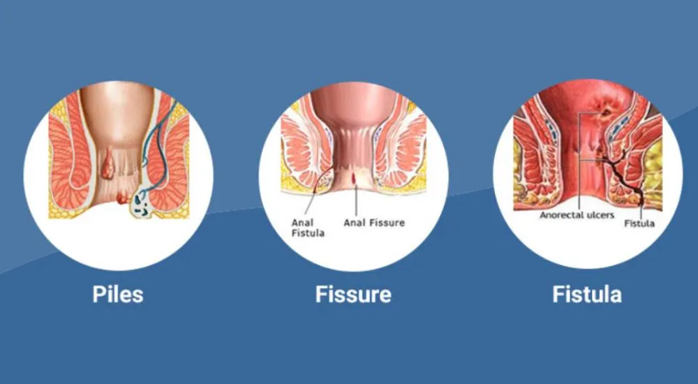 Piles/Fissure/Fistula image 1