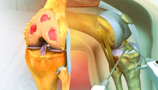 ACL & PCL Reconstruction image 1