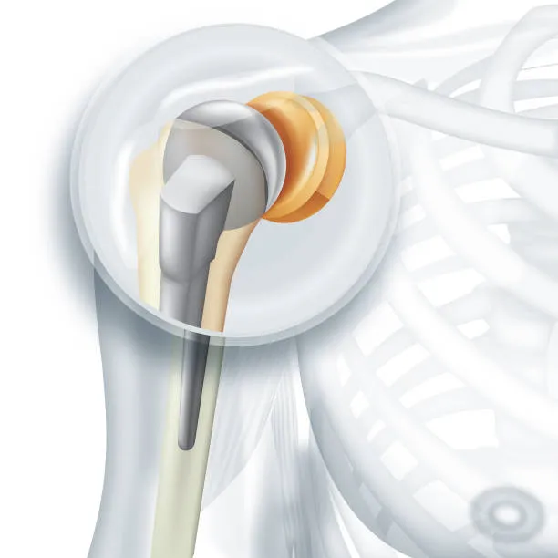 Shoulder Replacement image 1