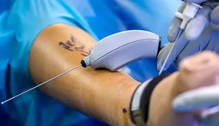 Joint Replacement Surgeries image 1